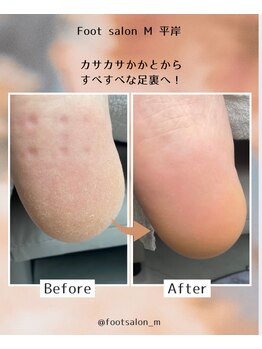 【足裏角質ケア】50代男性