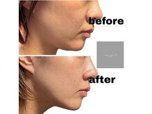 小顔たるみケアハイパーナイフ×脂肪分解レモンボトル