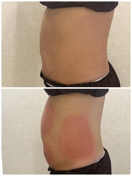 リアウェイク(Reawayke)/脂肪冷却1回目の効果