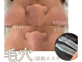 ラシュール(la sur)の写真/【黒ずみ/開き毛穴を撃退】ナノ技術で深部まで洗浄＆高濃度美容液を導入し、泥パックで毛穴レスを叶える♪