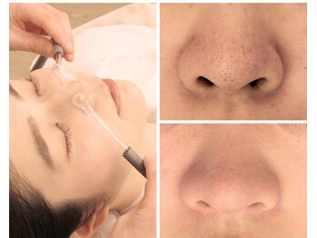 北原美顔/30代女性/毛穴黒ずみ改善