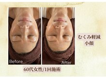 サロン カズリナ(Salon Kazrina)/ハーブピーリング1回の変化