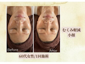 サロン カズリナ(Salon Kazrina)/ハーブピーリング1回の変化