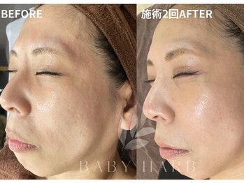 フィズ 戸塚店(FIS)/☆ハーブピーリング☆都度払い