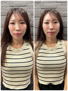 長寿鍼灸院 長寿整骨院/ハリネズミ女優美容鍼効果★