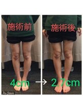 クシロ鍼灸整骨院/【O脚矯正】施術例