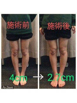 クシロ鍼灸整骨院/【O脚矯正】施術例