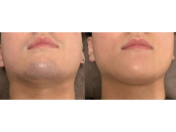 エルチェーロ(El Chulo)/ヒゲ脱毛