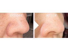 ボーテドゥマリエ(beaute de mariee)/毛穴ハイドロピーリング