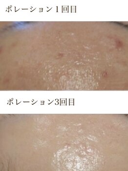 サロンドジョリーの写真/【くすみ・たるみ改善◎ニキビにアプローチ】幹細胞培養液高配合の施術で細胞のチカラを高めて最強肌