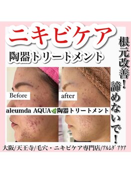アルムダアクア 天王寺店(Aleumda AQUA)/ハーブピーリング/大阪/天王寺
