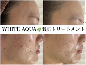 ホワイトアクア 広島店(WHITE AQUA)/ハーブピーリング/毛穴/小顔