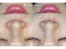 リル バイ アンドアール(Rire by and.R)/イオン導入×美白トリートメント