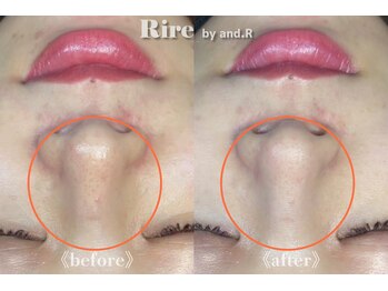 リル バイ アンドアール(Rire by and.R)/イオン導入×美白トリートメント