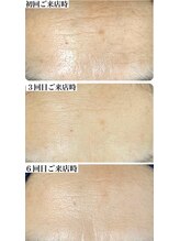 スティーン(Styin)/どんどん肌が変わる【京丹後市】