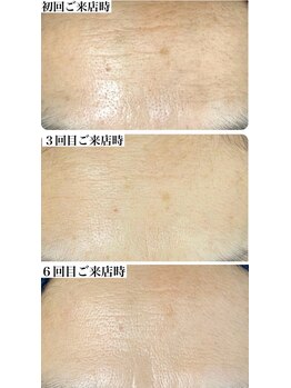 スティーン(Styin)/どんどん肌が変わる【京丹後市】