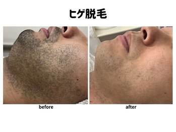 ゴールドプラス 都城店(GOLD PLUS)/ヒゲ脱毛
