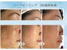【平日11時～15時限定】5,500円★剥離しない肌質改善ハーブピーリング60分