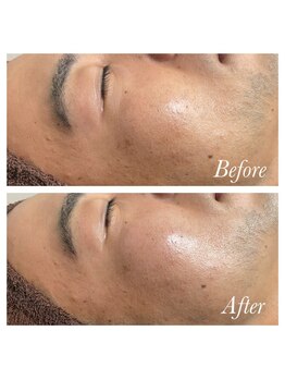 ミノア 大野城店(MINOA)/毛穴・ニキビケア・シミケア