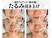 トゥモロー(TOMORROW)の雰囲気（瞬時にリフトアップ。さよなら二重あご。）