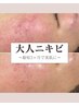 【4週間以内】美肌ハーブピーリング¥15,400→¥11,000