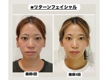 真美(Sinbi)/リターンフェイシャル