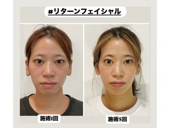 真美(Sinbi)/リターンフェイシャル