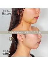 術後の女神 大阪心斎橋店/術後ケアインディバ・インディバ