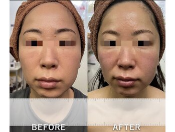 リラクゼーションサロン ラキ(laki)/サーモシェイプDEEPフェイシャル