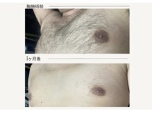 クレビア(CREVIA)/メンズ胸脱毛◆BeforeAfter