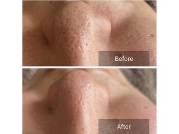 リノリー(rinory)/毛穴ケアは新常識