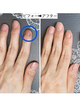 桃の木 吉祥寺店/深爪も自爪育成で健康に育てる