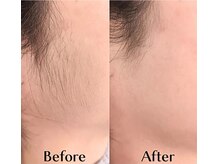 エム(M)/フェイス脱毛