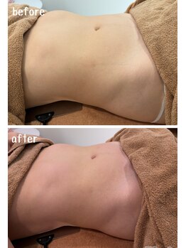 ラディアント(Radiant)/インディバ×レモンボトル