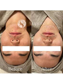 ルプレ(Lupure)/ハーブピーリング7回目