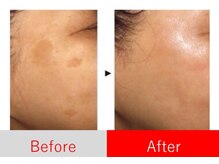 年齢肌のお悩みに圧倒的変化諦めない肌、始めませんか？