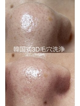 フェリシダージ(felicidade)/韓国式3D毛穴洗浄