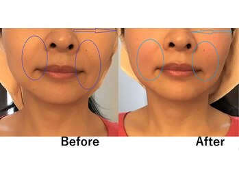 ビオモ 銀座(BIOMO)/ほうれい線撃退！