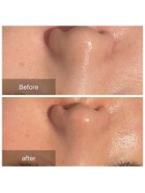 ブランスパ(Bulan Spa)/お客様の毛穴も改善しています。