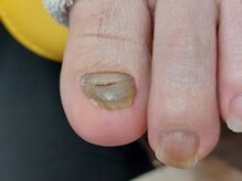 爪切り屋 足楽/肥厚爪★厚く伸びない【before】