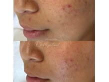 ベルアイラッシュ(Belleyelash)/【フェイシャルワックス】