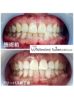 ホワイトニングサロン 京都烏丸店/ホワイトニング施術例