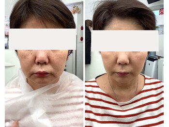 北原美顔/50代女性/リフトアップ効果