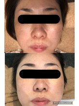 グロウ(glow)/ハーブピーリング1回目