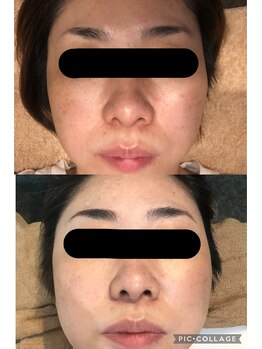 グロウ(glow)/ハーブピーリング1回目