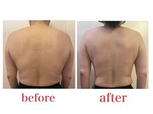 ブロッサム 山内店/40代☆背中痩せ＆姿勢改善