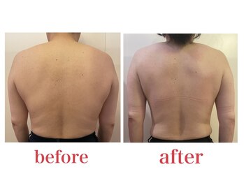 ブロッサム 山内店/40代☆背中痩せ&姿勢改善