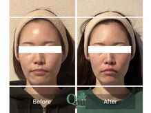 キュープ 練馬店(Qpu)/【小顔頭蓋骨矯正4回コース】