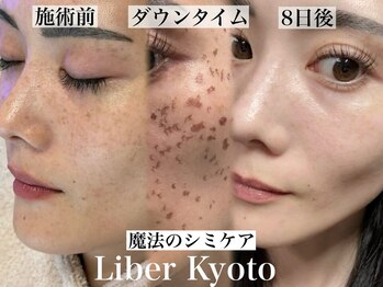リベルキョウト 京都駅前店(Liber Kyoto)/魔法のシミケア