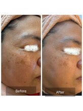 エメ(Aimer)/【50代日光性シミ結果写真☆】